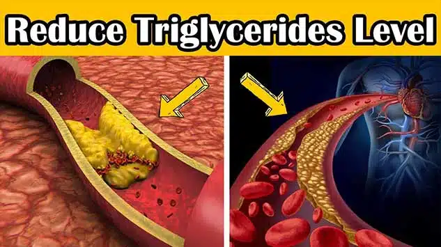 a picture demonstrating the effects of blood triglycerides. 